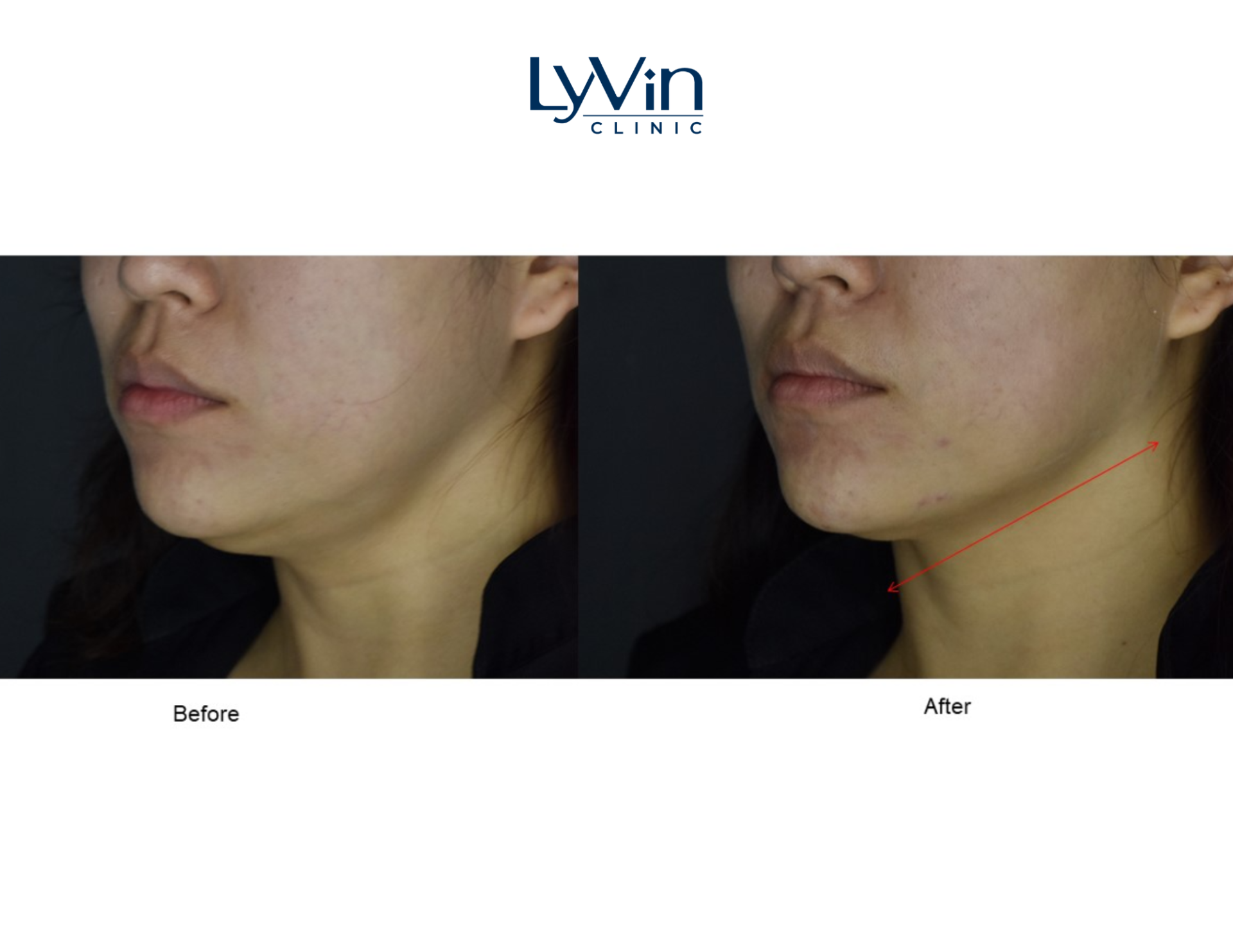 Jawline Filler in Johor Bahru | Lyvin Clinic JB